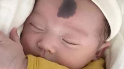 孕期这样做 远离宝宝胎记烦恼 准妈们要记牢这4点