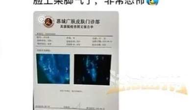 男子健身后脸上染“脚气”，多人曾中招：坐了一会儿，屁股就长了一片痘痘