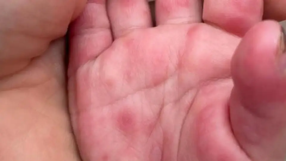 防治手足口病：专属居家消毒指南