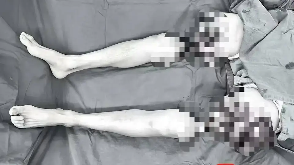 男子双大腿被绞断完全分离，经手术重新“接”回